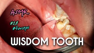 ASMR Decayed Wisdom Tooth Extraction 4k [upl. by Atsahc]