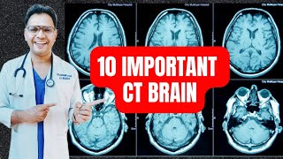 10 Important CT Brain radiology neuroradiology [upl. by Nnylesor513]