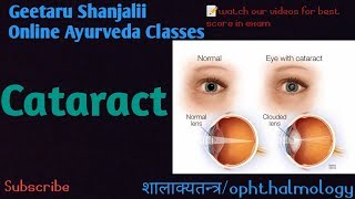 Cataract by Geetaru ophthalmology shalakyatantra BAMS AYURVEDA Gitaru Shanjalii Bams Netr Rog [upl. by Enimassej206]