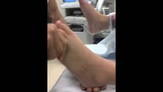 Pre and Postop Tarsal Coalition Surgery Intraoperarive Video SFISM [upl. by Yerocal]