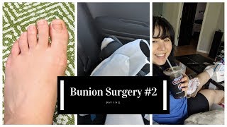 Bunion Surgery 2 [upl. by Yttisahc]