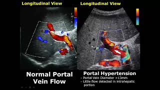 Liver Ultrasound Normal Vs Abnormal Image Appearances Comparison  Liver Pathologies USG [upl. by Selhorst158]