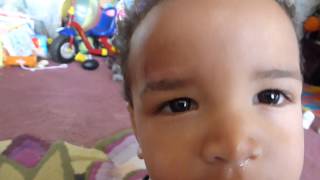 183 month old baby Emperor 3 weeks using Mederma for Kids [upl. by Mcleod]