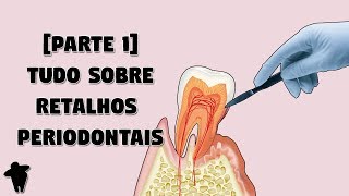 Aula de Periodontia  Cirurgia Periodontal a Retalho  Indicações dos Retalhos Periodontais [upl. by Nyltiac]