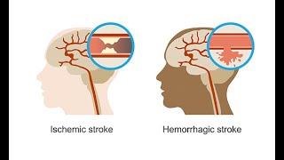 Recognizing hemorrhagic strokes–Neurology Masterclass [upl. by Benni]