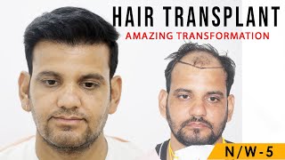 The Best Hair Transplant in India in best Cost  Medispa India  Dr Suneet Soni [upl. by Otinauj]