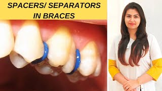 What Are Separators Spacers In Braces amp How Are They Put On  What is the first step in braces [upl. by Elliven]