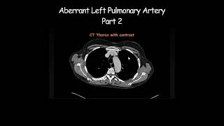 Aberrant Left Pulmonary Artery Part 2 radiology radiologist anatomy [upl. by Naor746]