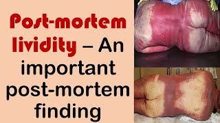 Postmortem lividity  An important postmortem change [upl. by Henderson668]