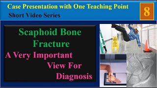 Scaphoid Bone Fracture Case Presentation with One Teaching Point [upl. by Georgianna]