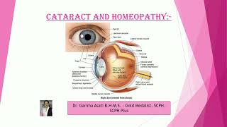 eye cataract treatment without surgery  cataract eye treatment  cataract on UDEMY  dr garimaasati [upl. by Dorolisa]