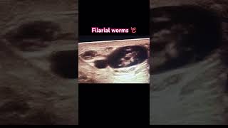 Filarial worms radiology ultrasonography medicine clinical [upl. by Aihsatan735]