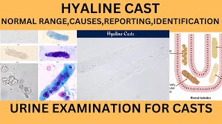 HYALINE CASTS IN URINECAUSES SYMPTOMS TREATMENT OF HYALINE CASTS IN URINE EXAMINATION IN HINDI [upl. by Atinuahs337]