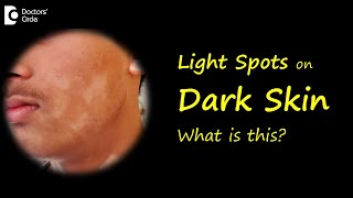 LIGHT SPOTS amp PATCHES ON BROWN OR DARK SKIN Causes amp Treatment  DrNischal K  Doctors Circle [upl. by Amik]