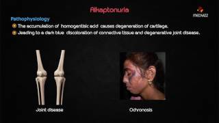 Ochronosis or Alkaptonuria  Usmle step 1 lecture [upl. by Tessler]