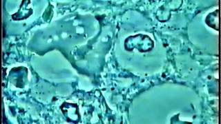 Periodontitis Amebiasis during pregnancy biofilm reality Complete movie [upl. by Alfonso]