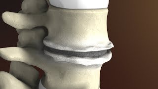 Degenerative Disc Disease Spondylosis explained by Spine Surgeon Dr Jessica Shellock Plano TX [upl. by Nareht611]