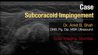 MSK Ultrasound  Subscapularis tendon calcification Subcoracoid Impingement [upl. by Ainyt]