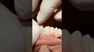 Class IV composite restoration dentist satisfying [upl. by Max]