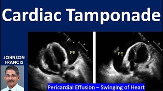 Cardiac Tamponade [upl. by Firman]