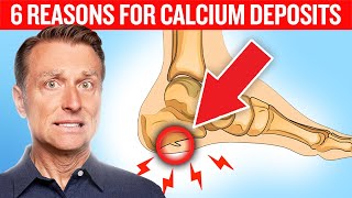 6 Reasons for Calcium Deposits Spurs Osteophytes Stones and Tartar [upl. by Mansoor]