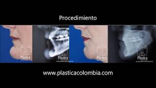 Reducción mentón  Genioplastia  Mentoplastia [upl. by Eelinnej]