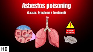 Asbestos Poisoning Causes Symptoms and Treatment [upl. by Arymas373]