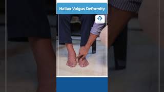 Hallux Valgus Deformity  Causes  Symptoms  Treatment  Foot Pain  Dr Vamshis Orthopaedic Center [upl. by Erdnassak]