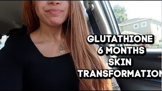 6 Months Of Glutathione  Whats Happening To My Skin [upl. by Cain]