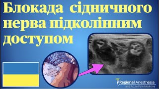 Блокада сідничного нерва підколінним доступом 🇺🇦 Popliteal Sciatic Nerve Block [upl. by Orteip]