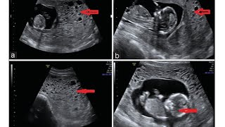 Partial Molar Pregnancies [upl. by Anyela]