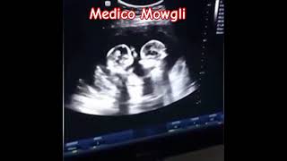 📌Intrauterine quotfightquotIn the video the twins are pushing each other amnioticfluid sulcus neology [upl. by Yokum]