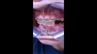 Braces Emergency  Broken Bite Plate  Broken Orthodontic appliance  Tooth Time Family Dentistry [upl. by Erusaert]