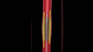 THE ULTIMATE ANGIOPLASTY ANIMATION  SEE HOW ITS DONE UP CLOSE [upl. by Richardo]