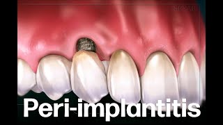 LAPIP Laser Assisted Peri Implantitis Procedure [upl. by Aneeres692]