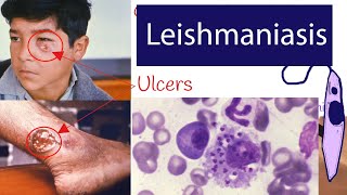 Leishmaniasis  Symptoms and Treatment of Leishmaniasis Explained under 3 minutes [upl. by Eceeryt]