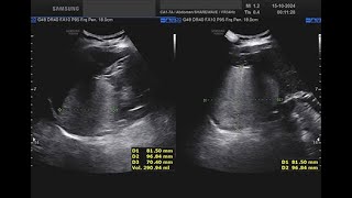 angiomiolipoma surrenalico destro [upl. by Gilbert]