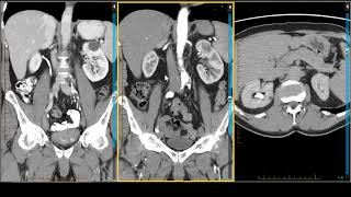 The Importance of MRI in Imaging Renal Masses [upl. by Retluoc]