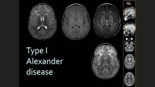 How to think about Diagnosis in the Leukodystrophies in 2020 [upl. by Dnomaj]