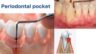 Periodontal Pocket [upl. by Yboj]