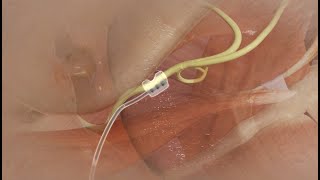 Hypoglossal Nerve Stimulator Device Implantation [upl. by Ellehsem]