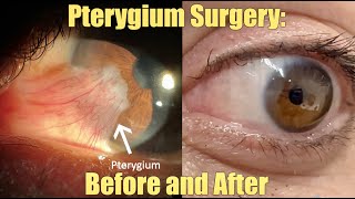 Ptergyium Surgery  Before and After What is it How we remove it Recovery and Results [upl. by Ilhsa]