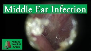 Ear Infection Pain Treatment in an Adult  Auburn Medical Group [upl. by Martinelli807]