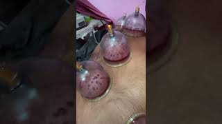 Wet cupping improves blood circulation and reduces inflammation sanjogaphysiotherapyclinic [upl. by Arikehs284]