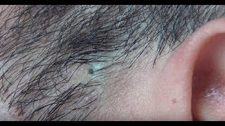 ingrown hair removal [upl. by Maryellen895]