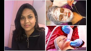 RF Micro Needling For Acne Scars Uneven Skintone amp Dark Circles  My Experience [upl. by Harshman]