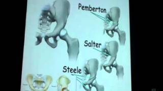 Osteotomies Around Hip Prof Dr Khaled Emara [upl. by Rees101]