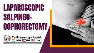 Laparoscopic Salpingooophorectomy for Recurrent Endometrioma A Comprehensive Video Overview [upl. by Barthol]