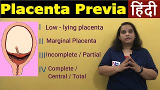 Placenta Previa in Hindi  APH Antepartum HemorrhageTypes Risk factors Symptoms  Nursing Lecture [upl. by Nwahsad]