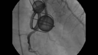 Two Views of the StarrEdwards Valves during Cardiac Catheterization [upl. by Brenan]